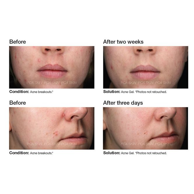 Hovedbilde Acne Gel